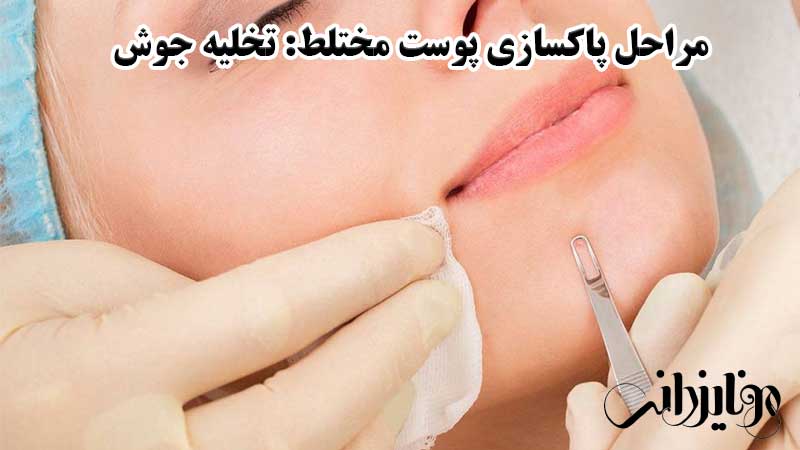 مراحل پاکسازی پوست مختلط در آرایشگاه؛ تخلیه جوش