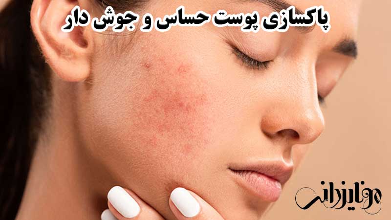 پاکسازی پوست حساس 7 پاکسازی پوست حساس و جوش دار