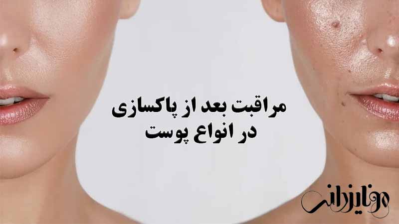 مراقبت بعد از پاکسازی برای انواع پوست
