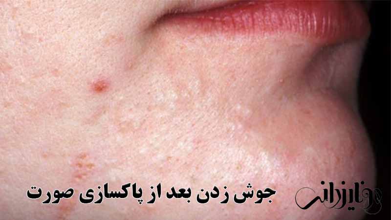 جوش زدن بعد از پاکسازی صورت